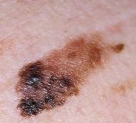 imagine cu melanom malign